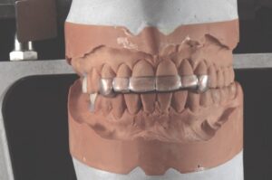 Dental cast showing a bite relationship