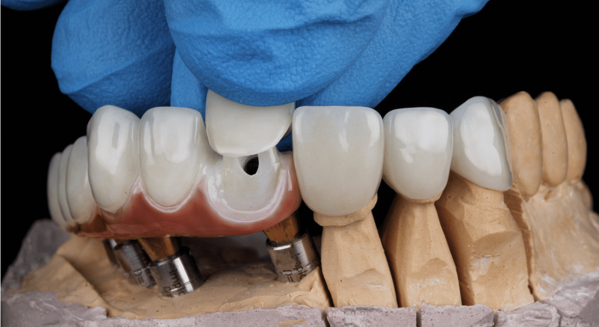 Dental implant-supported prosthesis on a model